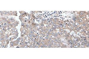 Immunohistochemistry of paraffin-embedded Human liver cancer tissue using BRMS1L Polyclonal Antibody at dilution of 1:45(x200) (BRMS1L Antikörper)