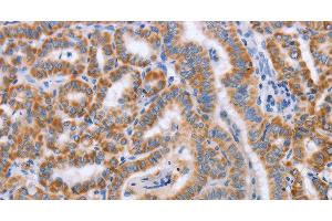 Immunohistochemistry of paraffin-embedded Human thyroid cancer tissue using BST1 Polyclonal Antibody at dilution 1:50 (BST1 Antikörper)
