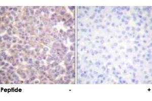Immunohistochemical analysis of paraffin-embedded human breast carcinoma tissue using ERBB3 polyclonal antibody .