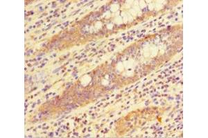 Immunohistochemistry of paraffin-embedded human colon cancer using ABIN7155348 at dilution of 1:100 (HIST1H1C Antikörper  (AA 2-213))