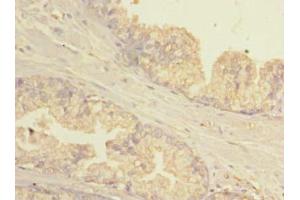 Immunohistochemistry of paraffin-embedded human prostate cancer using ABIN7154781 at dilution of 1:100 (GBP5 Antikörper  (AA 321-500))