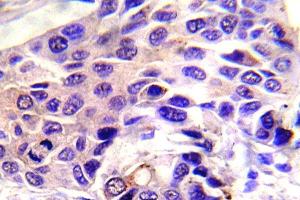 Immunohistochemistry (IHC) analyzes of p-GSK3alpha antibody in paraffin-embedded human breast carcinoma tissue. (GSK3 alpha Antikörper  (pSer21))
