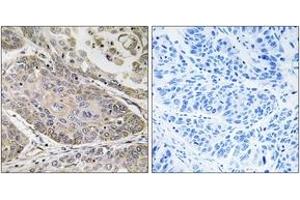 Immunohistochemistry analysis of paraffin-embedded human lung carcinoma, using PLA2G4E Antibody. (PLA2G4E Antikörper  (AA 401-450))