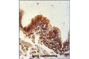 TXNDC6 antibody (Center) (ABIN654968 and ABIN2844606) immunohistochemistry analysis in formalin fixed and paraffin embedded human lung carcinoma followed by peroxidase conjugation of the secondary antibody and DAB staining. (NME9 Antikörper  (AA 111-139))