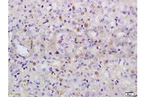 Formalin-fixed and paraffin embedded human liver carcinoma labeled with Anti-Phospho-Wee1(Ser642) Polyclonal Antibody, Unconjugated (ABIN746873) at 1:200 followed by conjugation to the secondary antibody and DAB (WEE1 Antikörper  (pSer642))