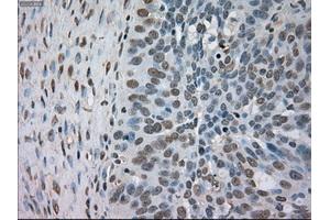 Immunohistochemical staining of paraffin-embedded Adenocarcinoma of colon tissue using anti-BUB1Bmouse monoclonal antibody. (BUB1B Antikörper)