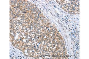 Immunohistochemistry of Human gastric cancer using PAPSS1 Polyclonal Antibody at dilution of 1:40 (PAPSS1 Antikörper)