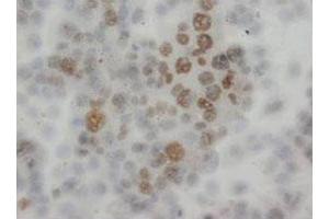 Immunohistochemical analysis of paraffin-embedded human epidermic carcinoma sections using API5 polyclonal antibody  . (Apoptosis Inhibitor 5 Antikörper  (C-Term))