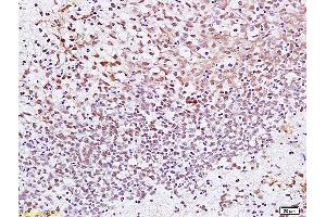 Formalin-fixed and paraffin embedded human gastric carcinoma labeled with Anti CENPF Polyclonal Antibody, Unconjugated (ABIN872667) at 1:200 followed by conjugation to the secondary antibody and DAB staining.
