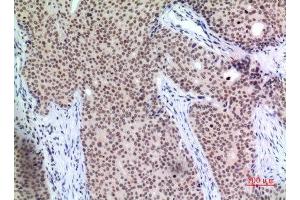 Immunohistochemistry (IHC) analysis of paraffin-embedded Human Mammary Cancer, antibody was diluted at 1:100. (P57 (Ser24) Antikörper)