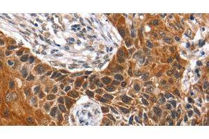 Immunohistochemistry of paraffin-embedded Human esophagus cancer tissue using HOXB1 Polyclonal Antibody at dilution 1:40 (HOXB1 Antikörper)