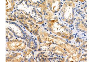ABIN6258004 and ABIN6275034 at 1/100 staining Human kidney cancer and adjacent normal tissues by IHC-P. (CD55 Antikörper  (Internal Region))
