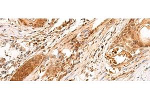 Immunohistochemistry of paraffin-embedded Human esophagus cancer tissue using SCAND1 Polyclonal Antibody at dilution of 1:90(x200) (SCAND1 Antikörper)