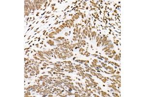 Immunohistochemistry of paraffin-embedded human colon carcinoma using Phospho-ST-Y705 Rabbit mAb (ABIN6135325, ABIN6136266, ABIN6136267 and ABIN7101883) at dilution of 1:100 (40x lens). (STAT3 Antikörper  (pTyr705))