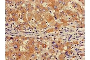 Immunohistochemistry of paraffin-embedded human liver cancer using ABIN7153517 at dilution of 1:100 (GABARAPL1 Antikörper  (AA 1-117))