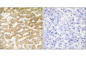 Immunohistochemistry analysis of paraffin-embedded human liver carcinoma tissue, using FADD Antibody. (FADD Antikörper  (AA 101-150))