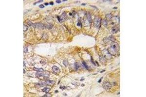 IHC analysis of FFPE human prostate carcinoma tissue stained with PDGFRA antibody
