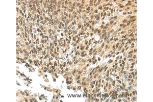 Immunohistochemistry of Human thyroid cancer using APOL6 Polyclonal Antibody at dilution of 1:60