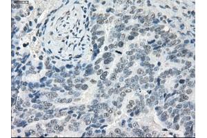 Immunohistochemical staining of paraffin-embedded Adenocarcinoma of colon tissue using anti-LTA4H mouse monoclonal antibody. (LTA4H Antikörper)