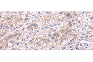 Immunohistochemistry of paraffin-embedded Human liver cancer tissue using G6PC Polyclonal Antibody at dilution of 1:50(x200) (G6PC Antikörper)