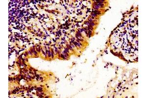 Immunohistochemistry of paraffin-embedded human lung cancer using ABIN7157878 at dilution of 1:100 (Laminin beta 1 Antikörper  (AA 523-661))