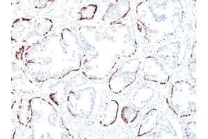 Formalin-fixed, paraffin-embedded human Prostate Carcinoma stained with Cytokeratin, HMW Mouse Monoclonal Antibody (34BE12). (Cytokeratin 2 Antikörper)
