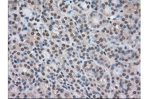 Immunohistochemical staining of paraffin-embedded Carcinoma of kidney tissue using anti-CTAG1Bmouse monoclonal antibody. (CTAG1B Antikörper)