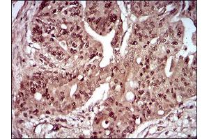 Immunohistochemical analysis of paraffin-embedded rectum cancer tissues using DAPK3 mouse mAb with DAB staining. (DAPK3 Antikörper  (AA 28-161))