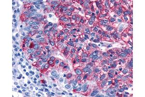 Anti-FZD3 / Frizzled 3 antibody IHC of human Ovary, Carcinoma. (FZD3 Antikörper)