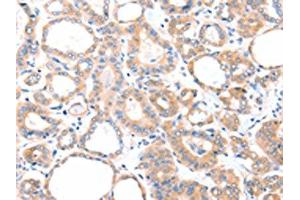 The image on the left is immunohistochemistry of paraffin-embedded Human thyroid cancer tissue using ABIN7128109(AADACL2 Antibody) at dilution 1/25, on the right is treated with fusion protein. (AADACL2 Antikörper)