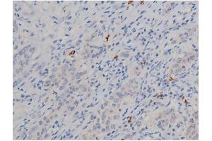 ABIN6267338 at 1/200 staining Human ganstric cancer tissue sections by IHC-P. (HSP90AB1 Antikörper  (pSer254))