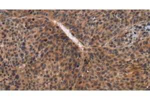 Immunohistochemistry of paraffin-embedded Human liver cancer using CDC34 Polyclonal Antibody at dilution of 1:50 (CDC34 Antikörper)