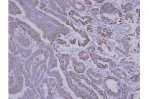 IHC-P Image Immunohistochemical analysis of paraffin-embedded human thyroid cancer, using SNX12, antibody at 1:100 dilution.