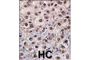 Formalin-fixed and paraffin-embedded human hepatocarcinoma tissue reacted with PEMT antibody (N-term) (ABIN650614 and ABIN2844055) , which was peroxidase-conjugated to the secondary antibody, followed by DAB staining. (PEMT Antikörper  (N-Term))