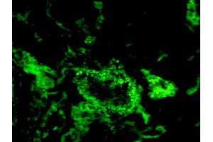 Formalin-fixed and paraffin-embedded human breast cancer labeled with Anti-CD150/SLAMF1 Polyclonal Antibody, Unconjugated (ABIN749468) 1:200, overnight at 4°C, The secondary antibody was Goat Anti-Rabbit IgG, FITC conjugated used at 1:200 dilution for 40 minutes at 37°C. (SLAMF1 Antikörper  (AA 231-335))