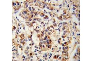 Immunohistochemistry analysis of human breast carcinoma (Formalin-fixed, Paraffin-embedded) using SPRR1B / Cornifin-B Antibody (C-term), followed by peroxidase-conjugated secondary antibody and DAB staining. (SPRR1B Antikörper  (C-Term))