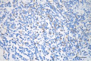 Immunohistochemistry was performed on paraffin-embedded human melanoma using phospho-PKC alpha (T497) antibody (ABIN7799986), 1:200).