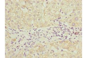Immunohistochemistry of paraffin-embedded human liver cancer using ABIN7164691 at dilution of 1:100 (PDCD2L Antikörper  (AA 1-358))