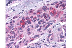 Anti-DUSP23 antibody IHC of human Skin, Melanoma. (DUSP23 Antikörper  (Internal Region))