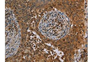 The image on the left is immunohistochemistry of paraffin-embedded Human cervical cancer tissue using ABIN7191746(OSM Antibody) at dilution 1/40, on the right is treated with synthetic peptide. (Oncostatin M Antikörper)