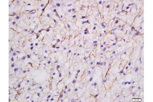 Formalin-fixed and paraffin embedded human glioma labeled with Rabbit Anti-MDGA2 Polyclonal Antibody, Unconjugated  at 1:200 followed by conjugation to the secondary antibody and DAB staining (MDGA2 Antikörper  (AA 751-850))