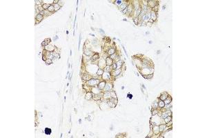 Immunohistochemistry of paraffin-embedded human gastric cancer using IER3 antibody (ABIN6134174, ABIN6142158, ABIN6142159 and ABIN6224665) at dilution of 1:100 (40x lens). (IER3 Antikörper  (C-Term))