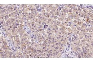 ABIN6273349 at 1/100 staining Human thyroid cancer tissue by IHC-P. (WSB1 Antikörper  (Internal Region))