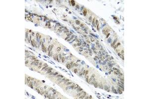 Immunohistochemistry of paraffin-embedded human colon carcinoma using TIA1 antibody (ABIN6293426) at dilution of 1:100 (40x lens).