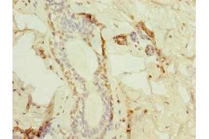 Immunohistochemistry of paraffin-embedded human breast cancer using ABIN7172975 at dilution of 1:100
