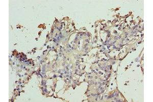 Immunohistochemistry of paraffin-embedded human breast cancer using ABIN7171951 at dilution of 1:100 (TTC9C Antikörper  (AA 1-171))