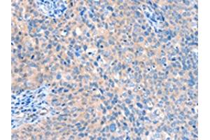 The image on the left is immunohistochemistry of paraffin-embedded Human cervical cancer tissue using ABIN7128170(ACOX1 Antibody) at dilution 1/20, on the right is treated with fusion protein. (ACOX1 Antikörper)