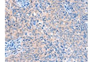 The image on the left is immunohistochemistry of paraffin-embedded Human cervical cancer tissue using ABIN7128170(ACOX1 Antibody) at dilution 1/20, on the right is treated with fusion protein. (ACOX1 Antikörper)