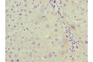 Immunohistochemistry of paraffin-embedded human liver cancer using ABIN7158038 at dilution of 1:100 (LRG1 Antikörper  (AA 36-346))