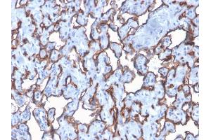 Formalin-fixed, paraffin-embedded human Angiosarcoma stained with CD31 Rabbit Recombinant Monoclonal Antibody (C31/2876R). (Rekombinanter CD31 Antikörper)